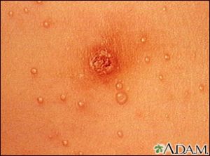 small, raised, and usually white, pink, or flesh-colored with a dimple or pit in the center