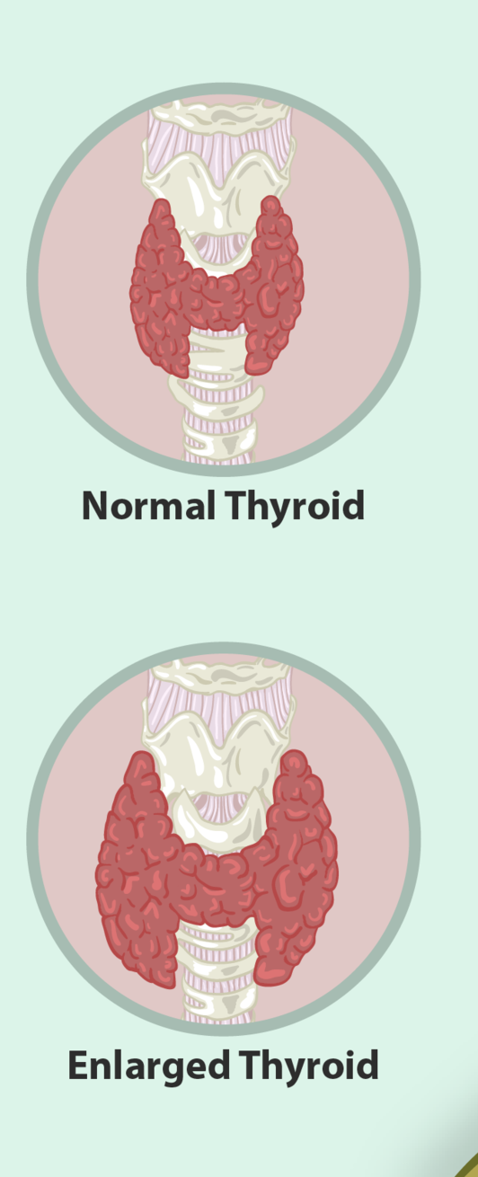 Enlarged thyroid