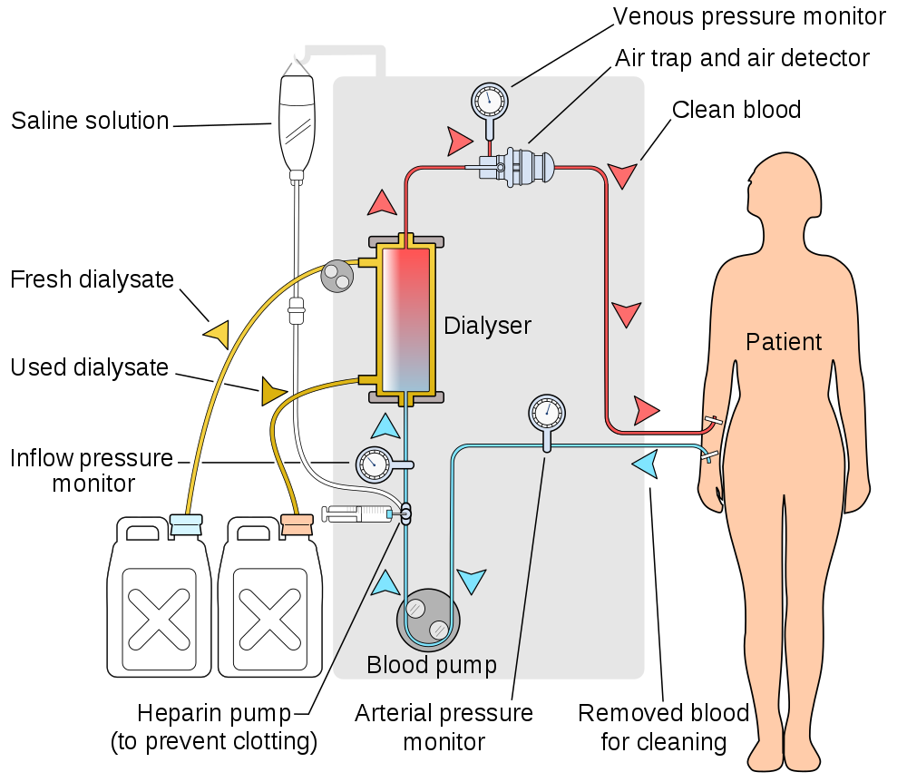 16.6.4 Hemodialysis