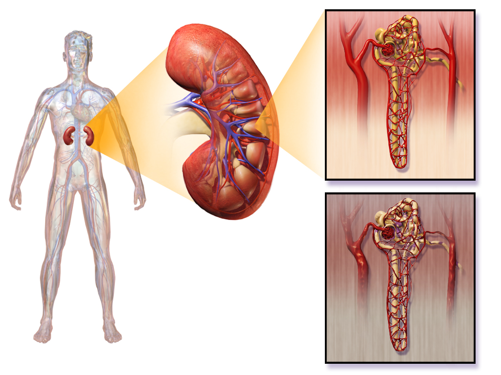 16.6.2 Diabetic Nephropathy