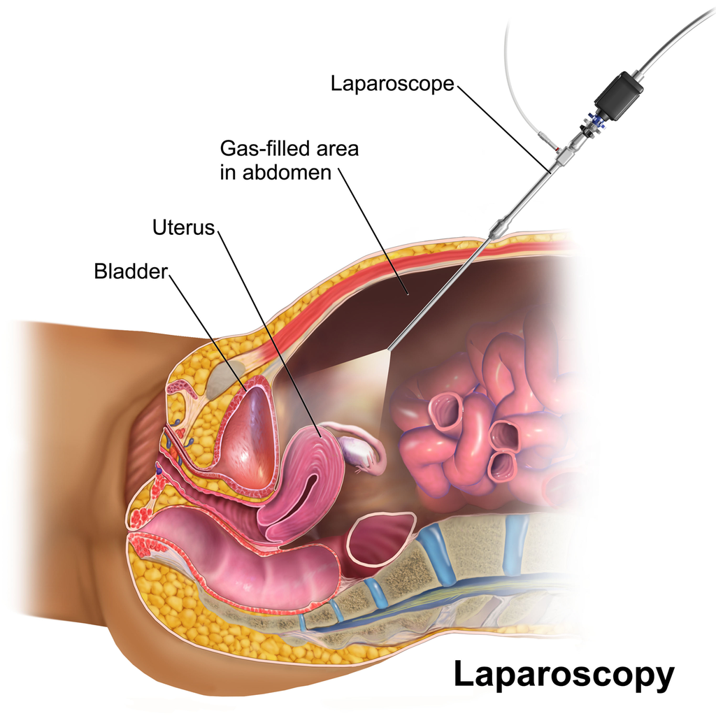 18.9.6 Laparoscopy