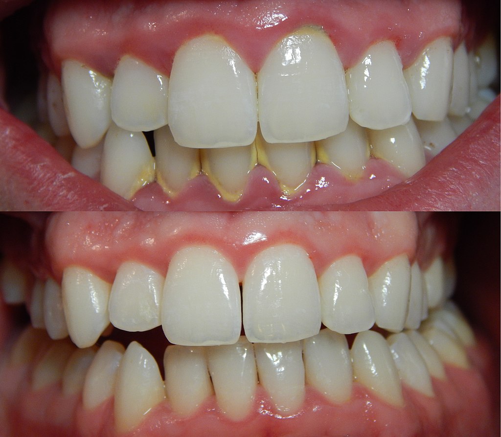 17.4.8 Gingivitis