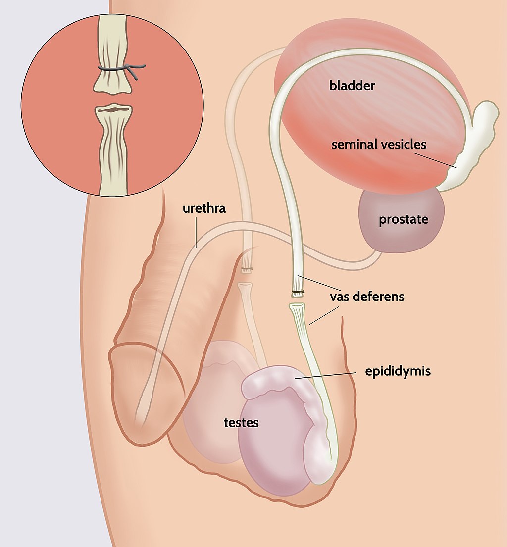 18.11.8 Vasectomy