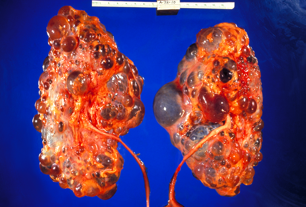 16.6.3 Polycystic Kidney Disease