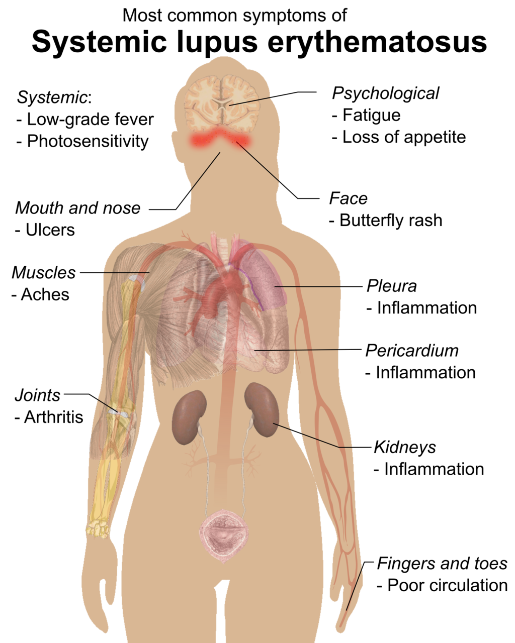 Figure 17.6.6 Symptoms of Lupus