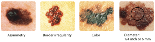 10.7 ABCDs of skin cancer