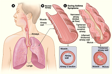 13.5.2 Asthma