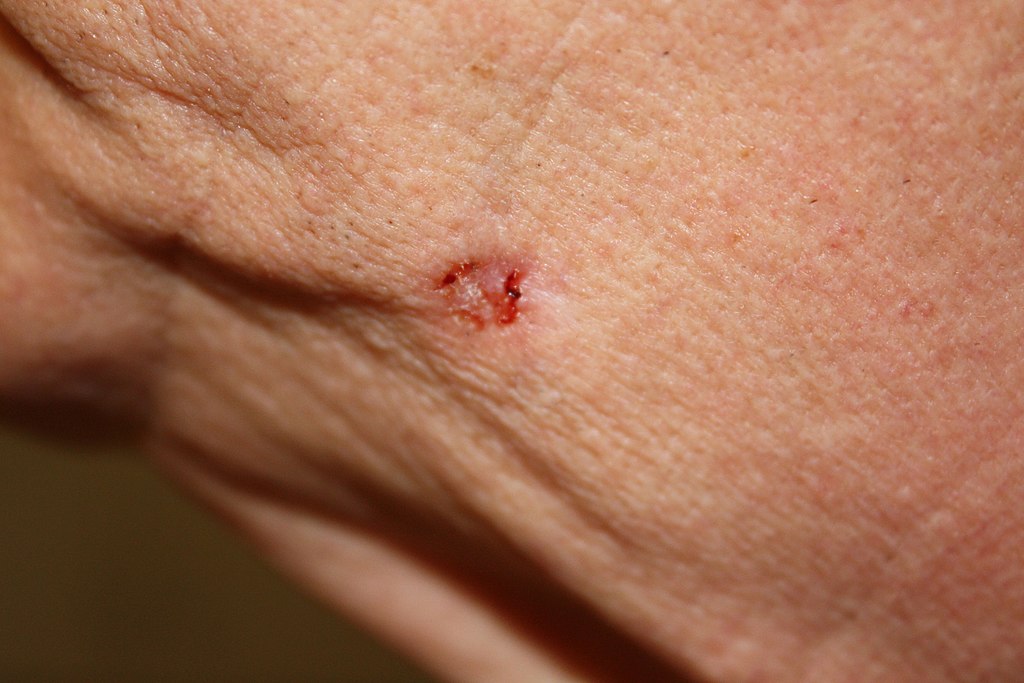 10.6 Basal Cell Carcinoma