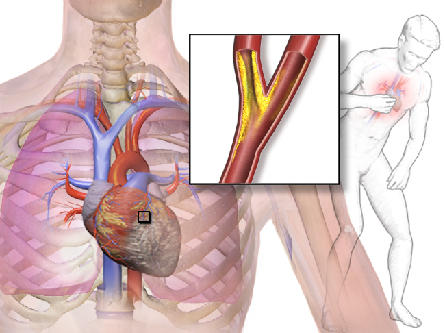 14.6.4 Angina