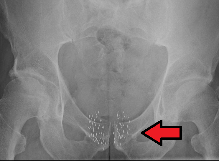 18.5.7 Brachytherapy