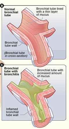 13.7.2 Bronchitis