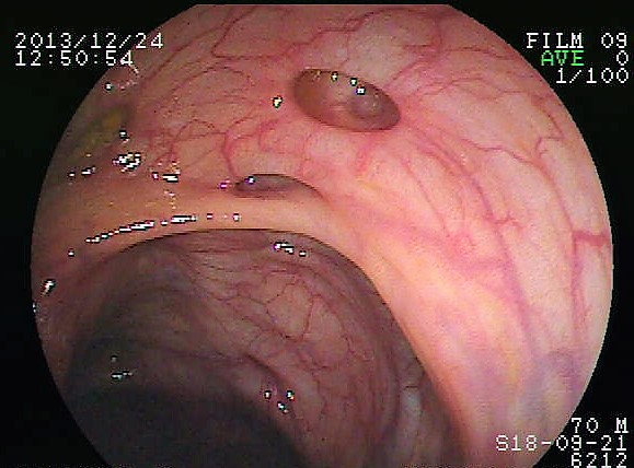 15.7.3 Diverticula