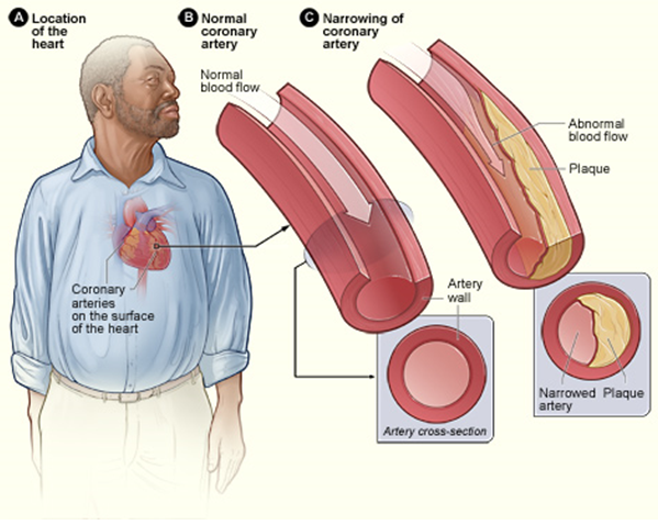 14.6.3 Coronary Heart Disease