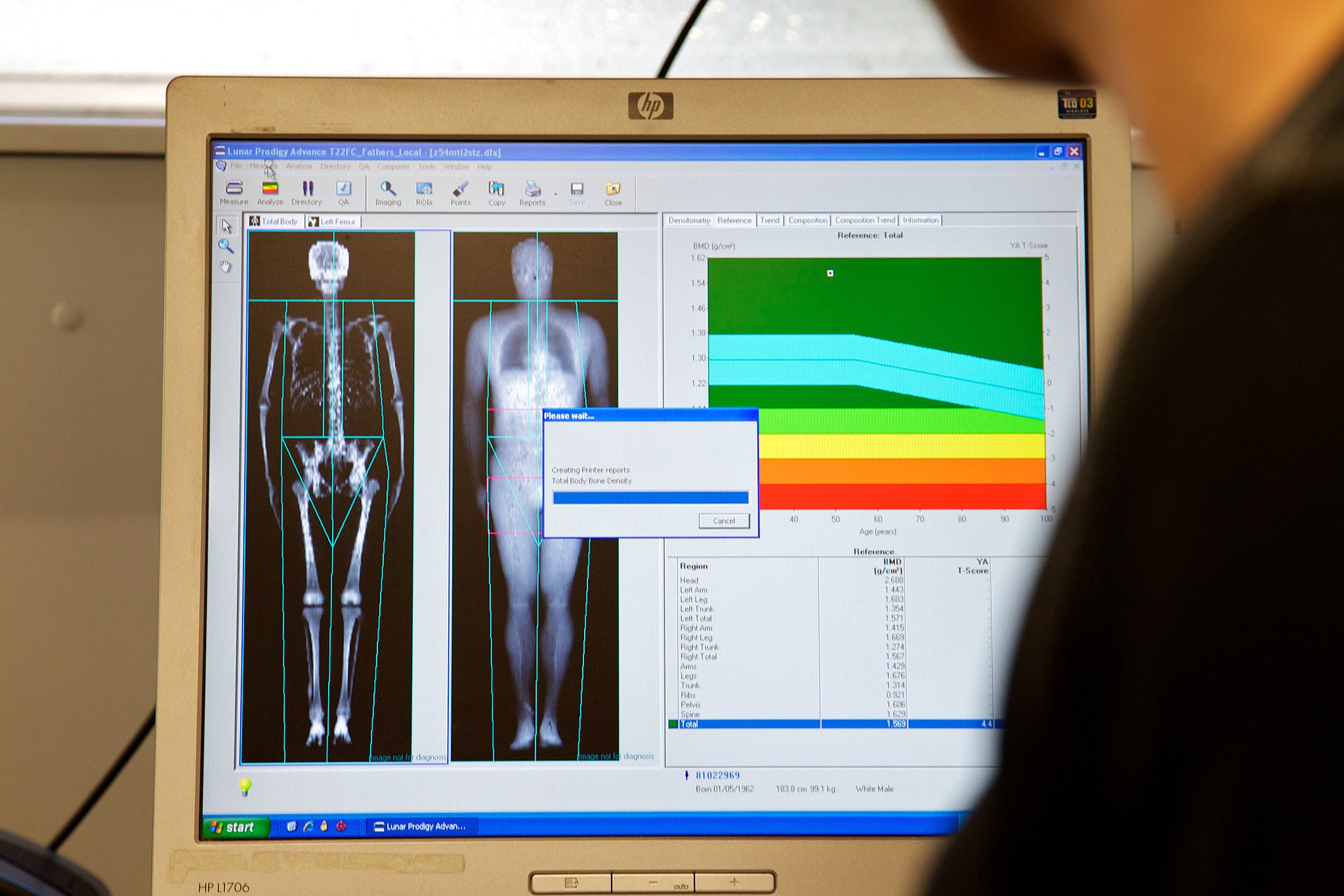 11.7.4 DEXA Scan