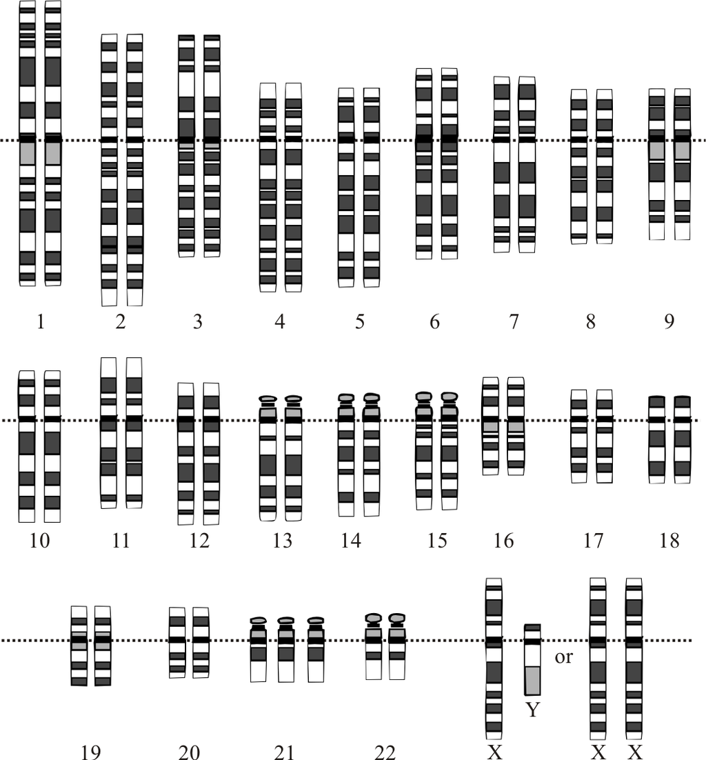 Down Syndrome Karyotype