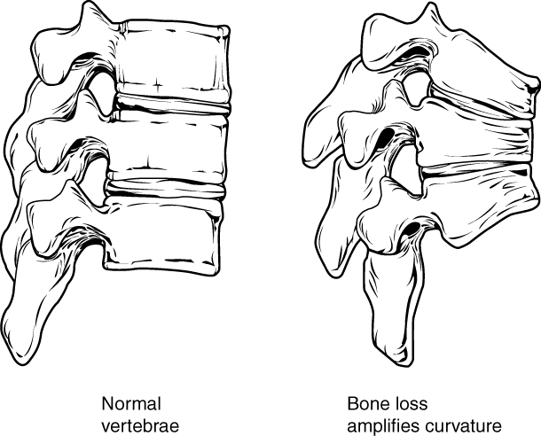 11.7 Kyphosis in the spine