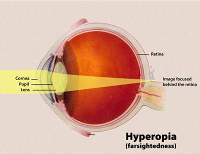 Hyperopia