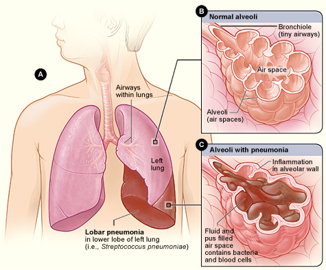 13.5.4 Pneumonia