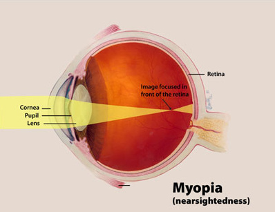 Myopia Diagram