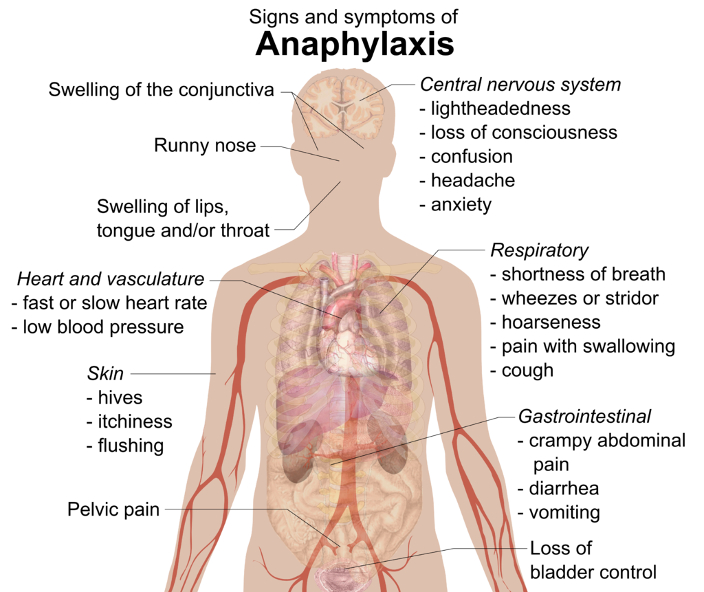 17.6.4 Signs and Symptoms of Anaphylaxis