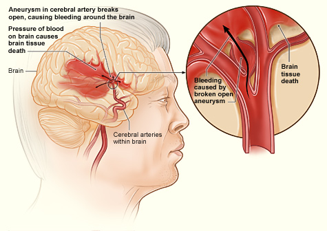 14.6.7 Hemorrhagic Stroke