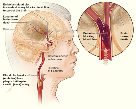 14.6.6 Ischemic Stroke