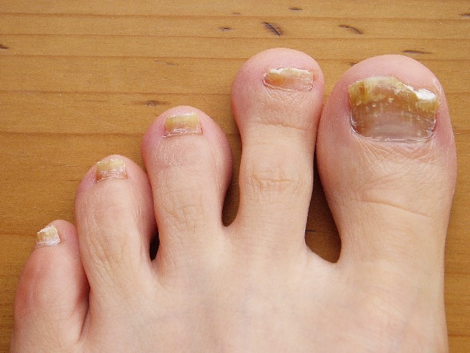 10.6 Toenail fungus