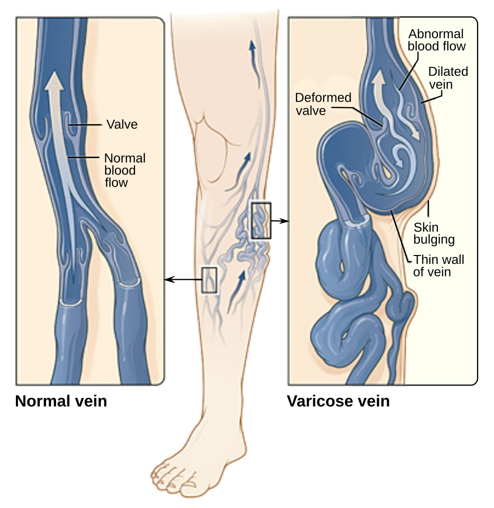 14.4.11 Varicose Vein Formation