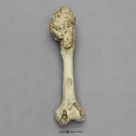 Osteosarcoma on a left human femur.