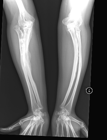 X-ray of the forearms of an individual with osteogenesis imperfecta.