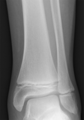 X-ray of a subadult’s ankle with the epiphyses of the tibia and fibula visible.