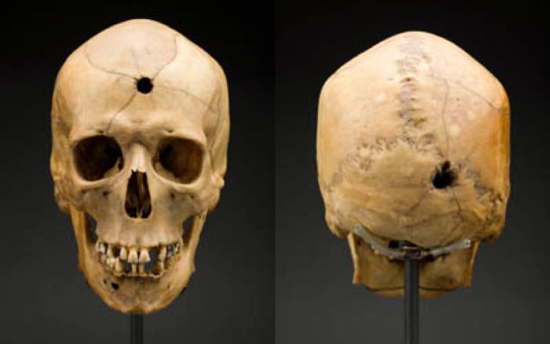 Example of projectile trauma with an entrance wound to the frontal bone and exit wound visible on the occipital