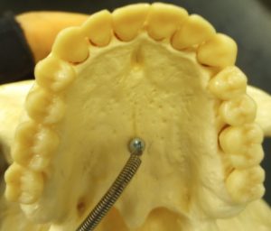 Upper dentition of an adult. All permanent teeth have erupted.