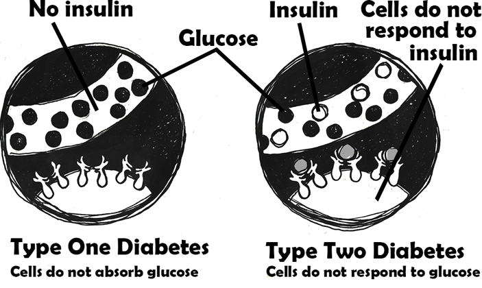 Type 1 and Type 2 Diabetes.