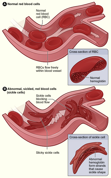 Normal and sickled erythrocytes.