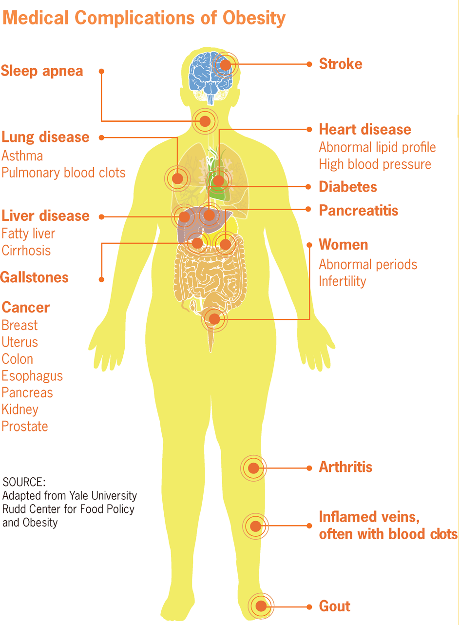 Medical Complications of Obesity.